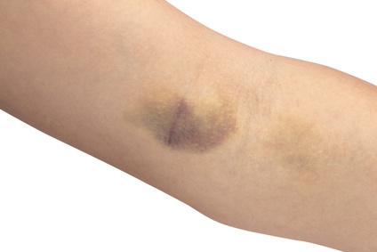 bruise on the white background